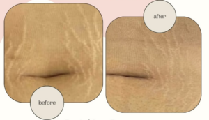 Treatment Scar Repair Regeneration